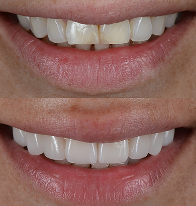 Diseño de Sonrisas