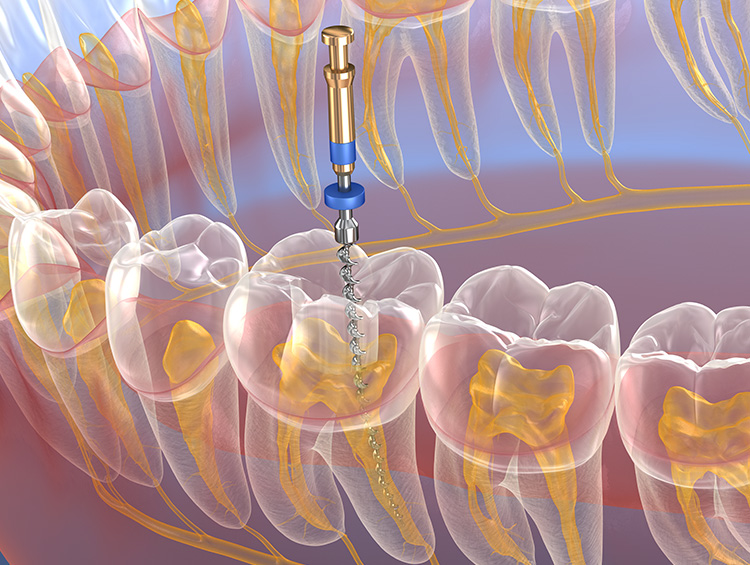 ENDODONCIA