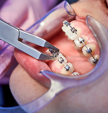 BRACKETS AUTOLIGADO