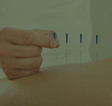 ACUPUNTURA